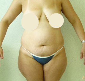 Tummy Tuck Before and After Results