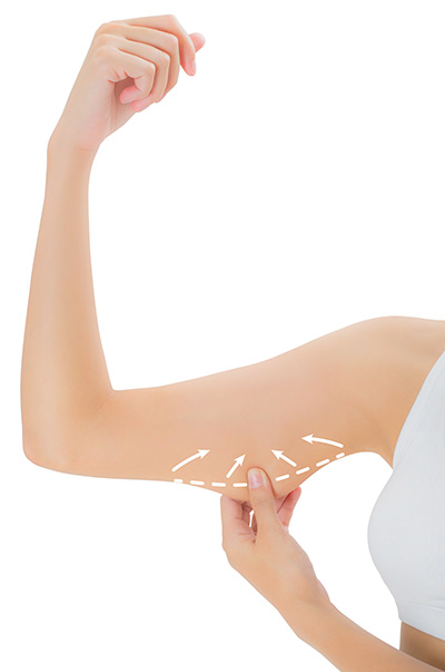 Upper Arm Lift Chicago