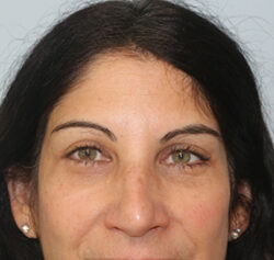 Blepharoplasty Before and After Results Blepharoplasty Before and After Results