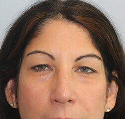 Blepharoplasty Before and After Results Blepharoplasty Before and After Results