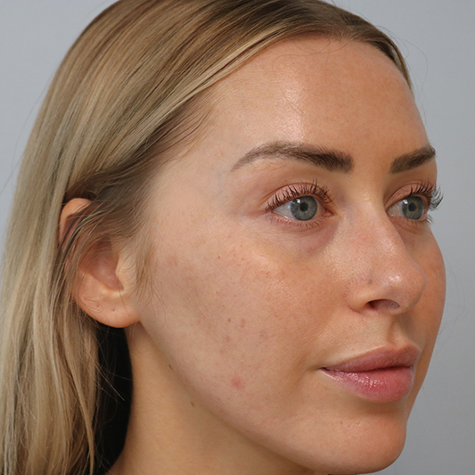 Rhinoplasty Before left oblique view Breast Augmentation Before and After Results